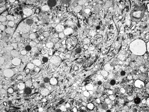 F, 59y. | pituitary adenoma (ACTH) … Crooke cell F, 59y. | pituitary adenoma (ACTH) … Crooke cell